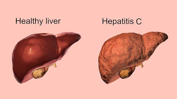 45,000 New Zealanders live with hepatitis C: health official