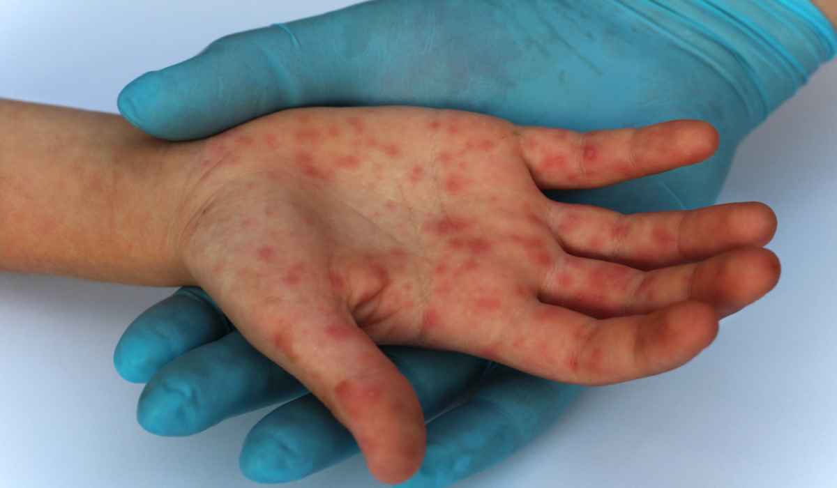 Measles patients detected in Jajarkot