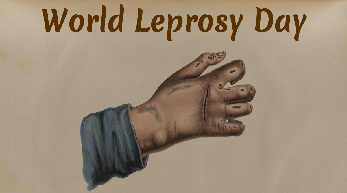 69th World Leprosy Day being observed today