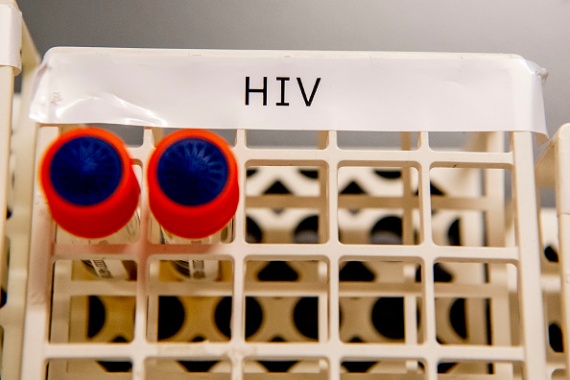First woman reported cured of HIV after stem cell transplant