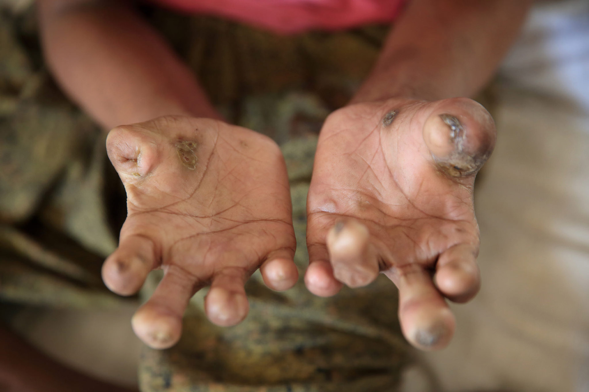 110 leprosy cases found inside Kathmandu metropolis in 2022-23