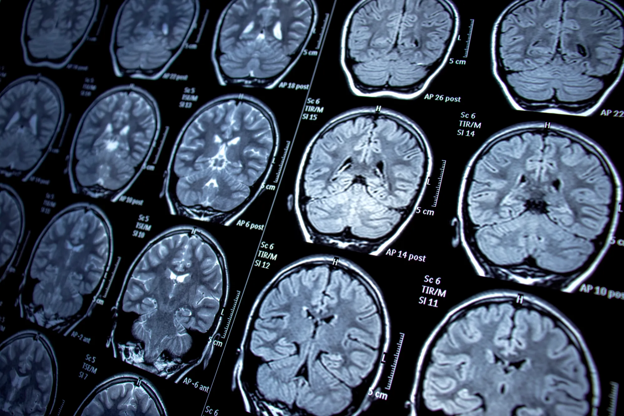 Covid-19 may cause changes in the brain, new study finds