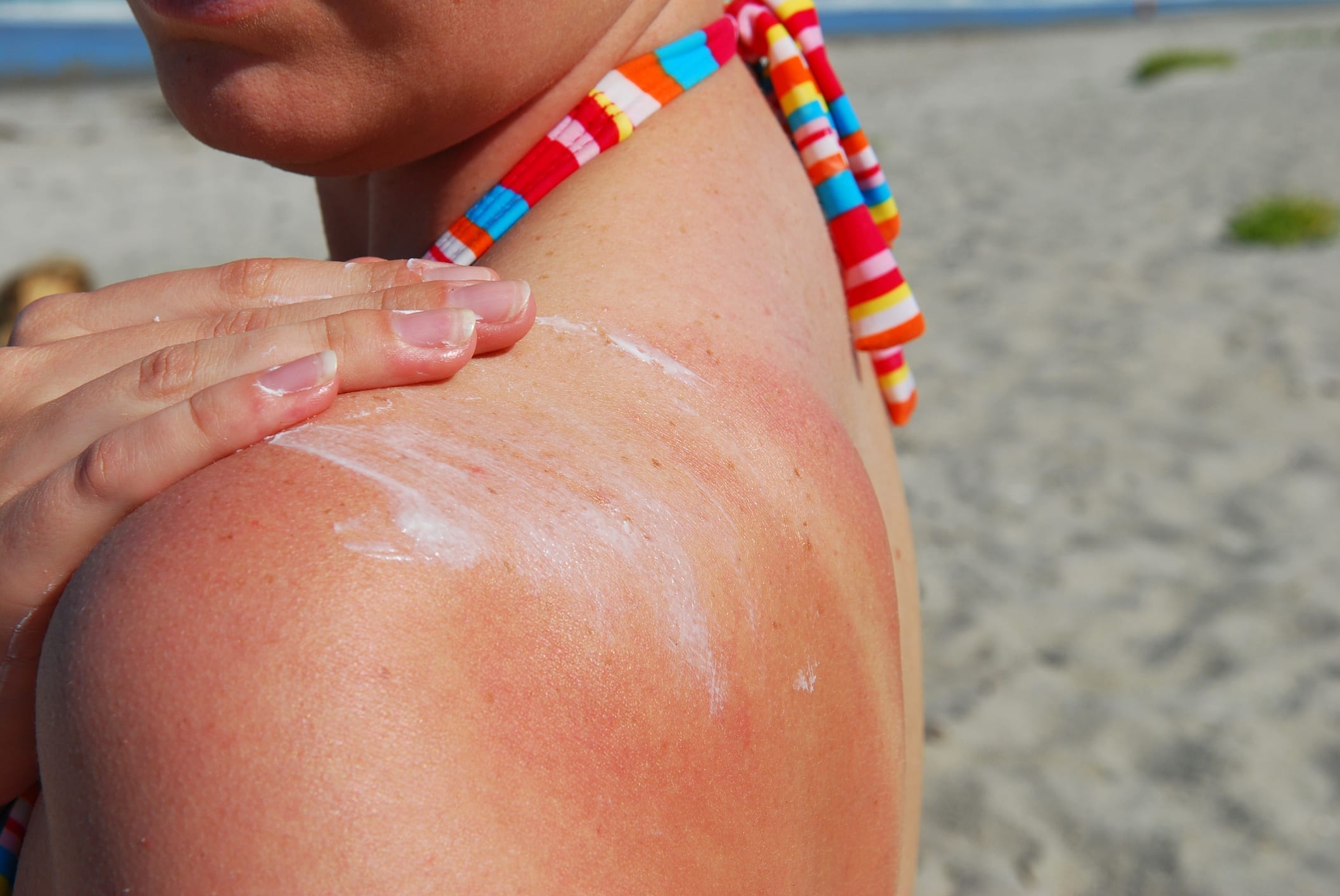 What you should know about sun poisoning symptoms