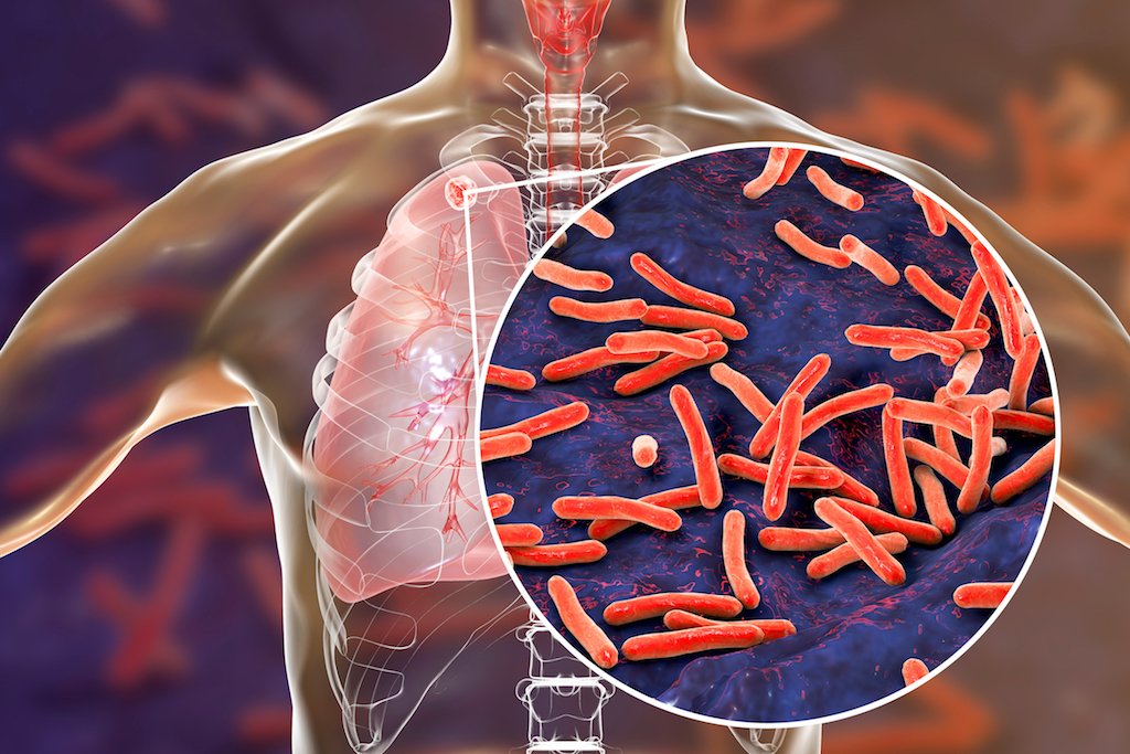 Around 60 percent tuberculosis cases go undiagnosed
