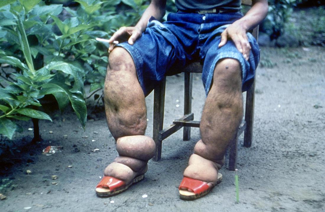 Villages in Baglung at risk of elephantiasis