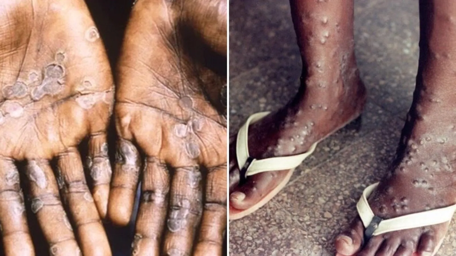 What you need to know about monkeypox