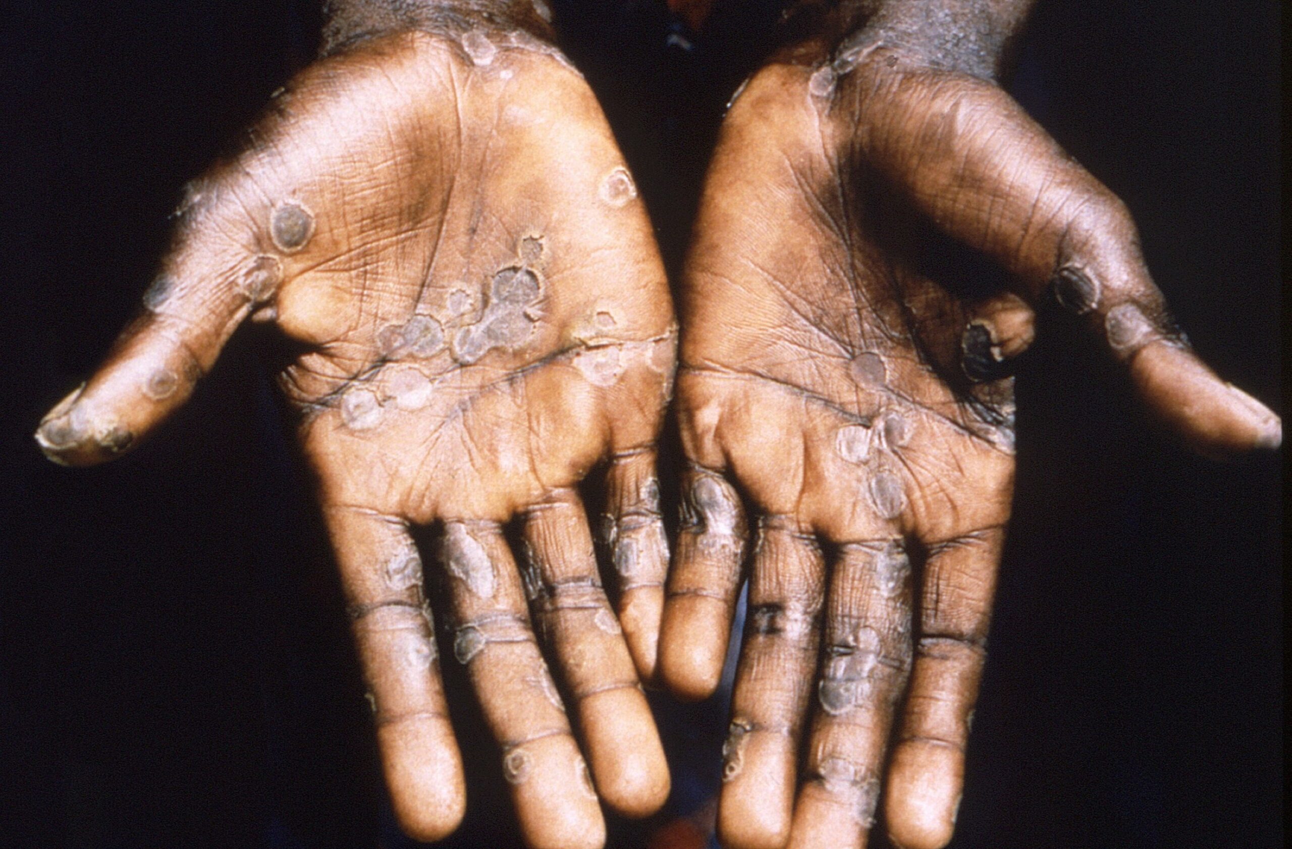 Israel confirms 1st monkeypox case