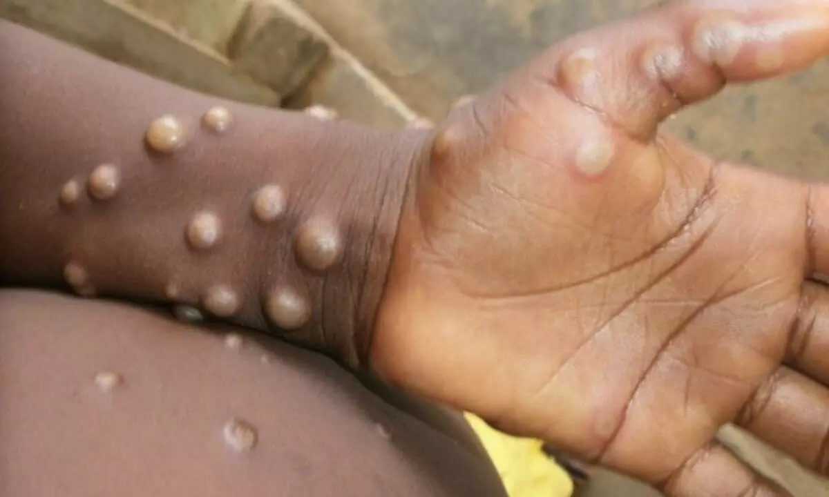 Monkeypox: 80 cases confirmed in 12 countries