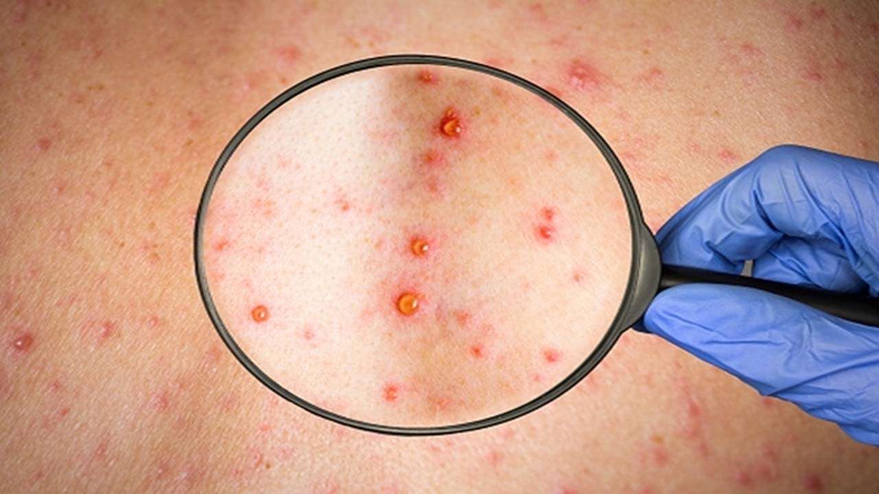 World’s monkeypox prep shows ugly truth – resources available, not for Africans