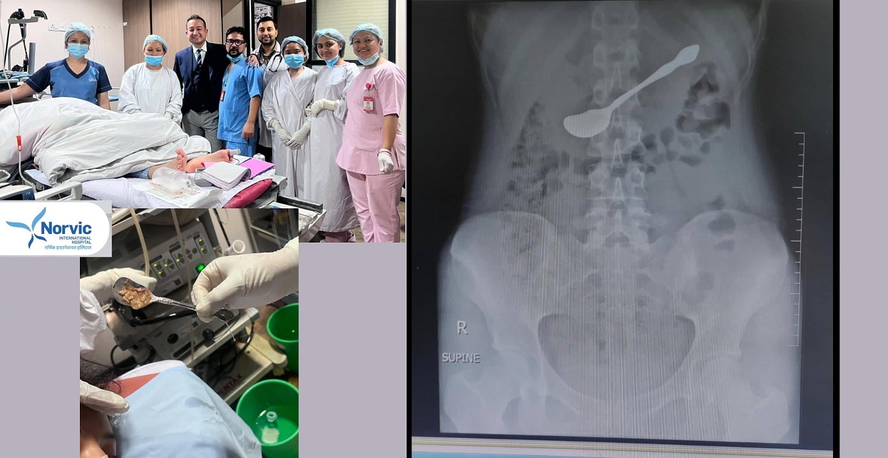 Doctor removed the spoon stuck in abdomen without surgery