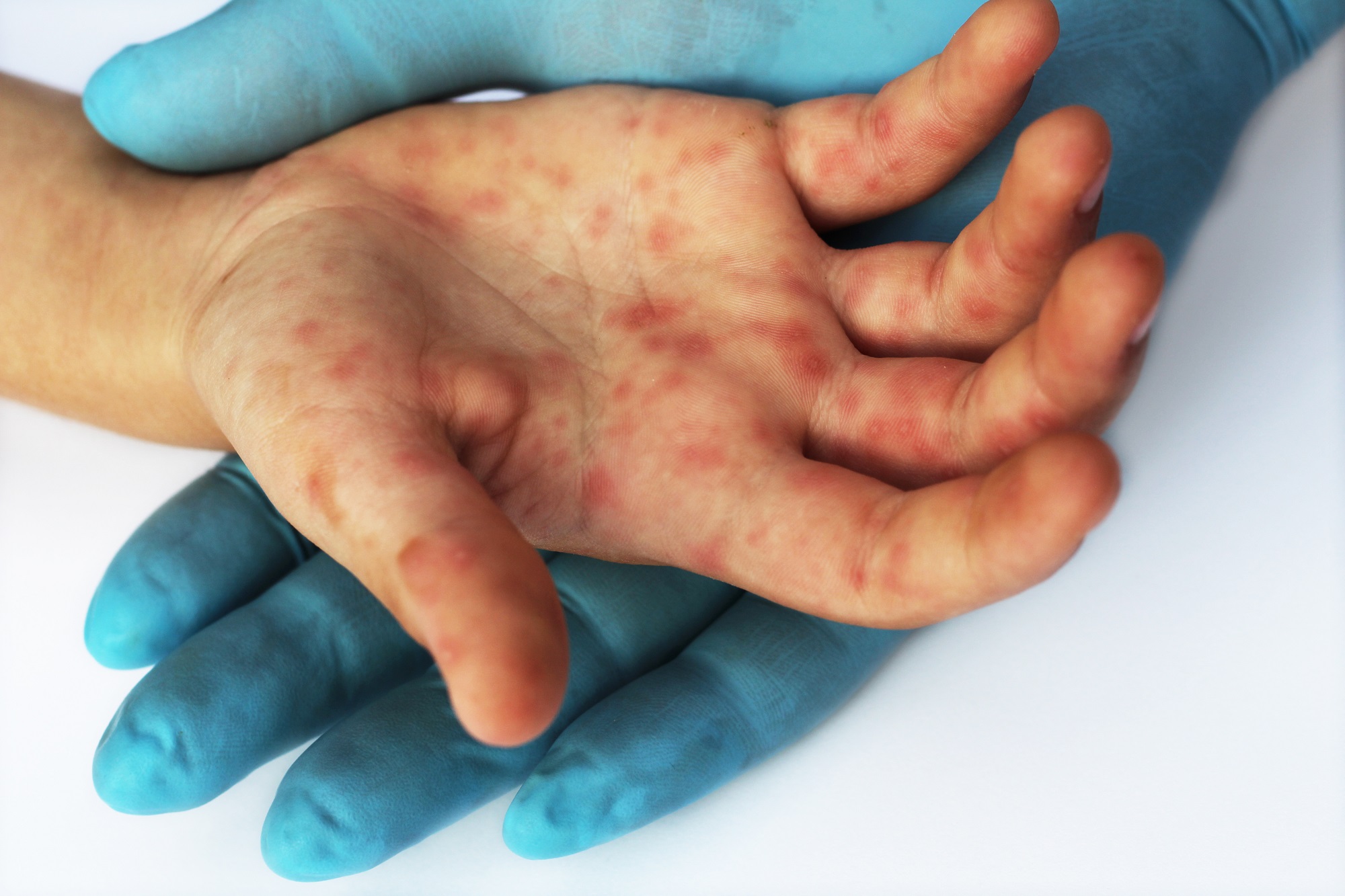 Indian gov’t issues advisory on hand, foot and mouth disease