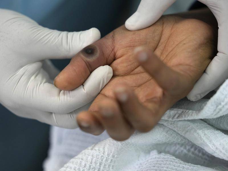 Cuba detects first monkeypox case in Italian tourist