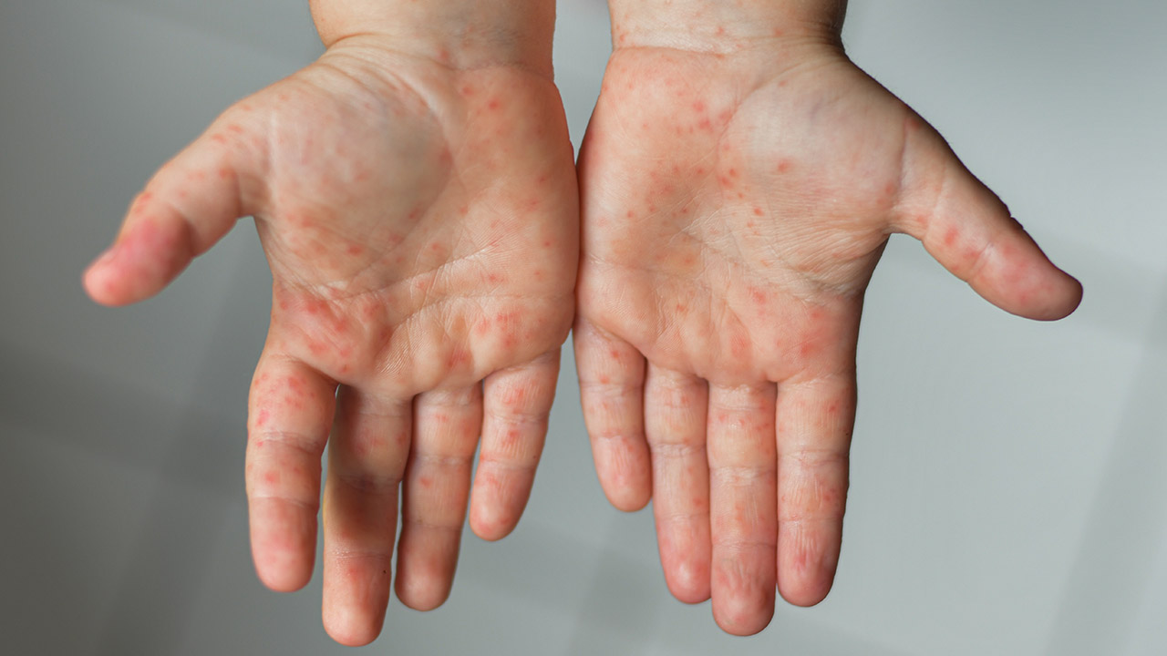 What to know about hand, foot & mouth disease