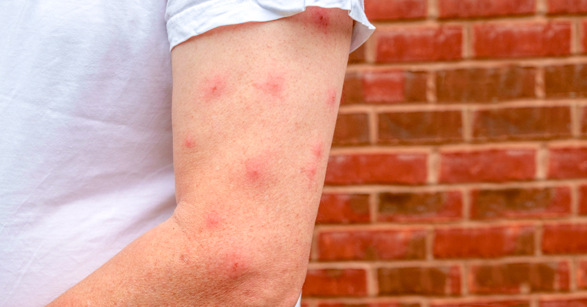What happens when a mosquito bite gets infected?