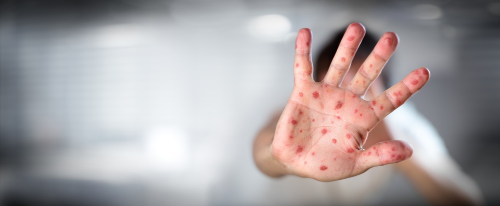 Measles cases detected in Jhapa