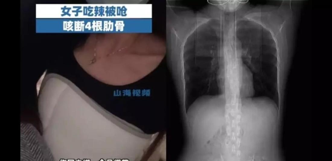 Chinese woman fractures 4 ribs while coughing after eating spicy food