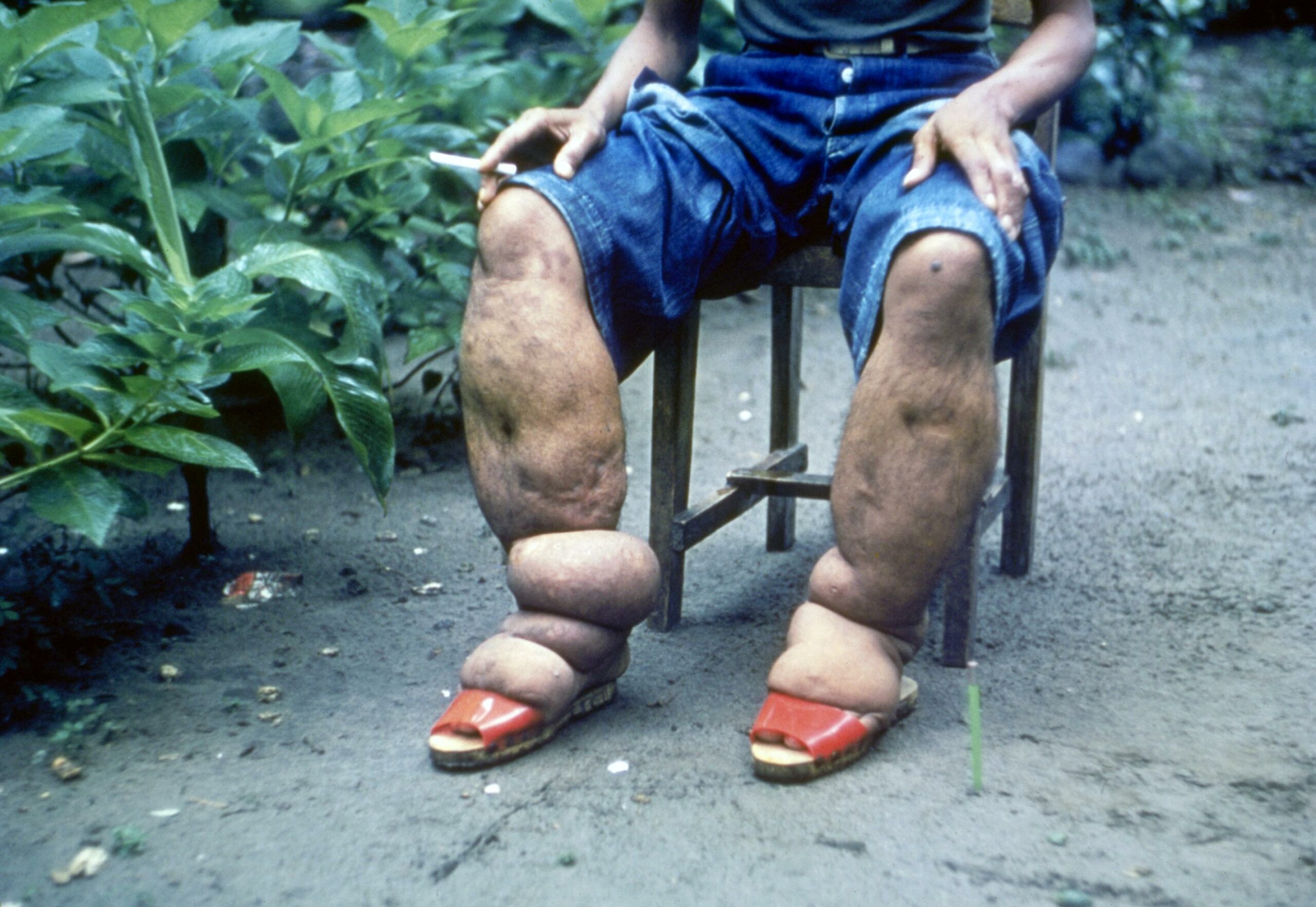 Mass drug administration against lymphatic filariasis in 15 districts from today