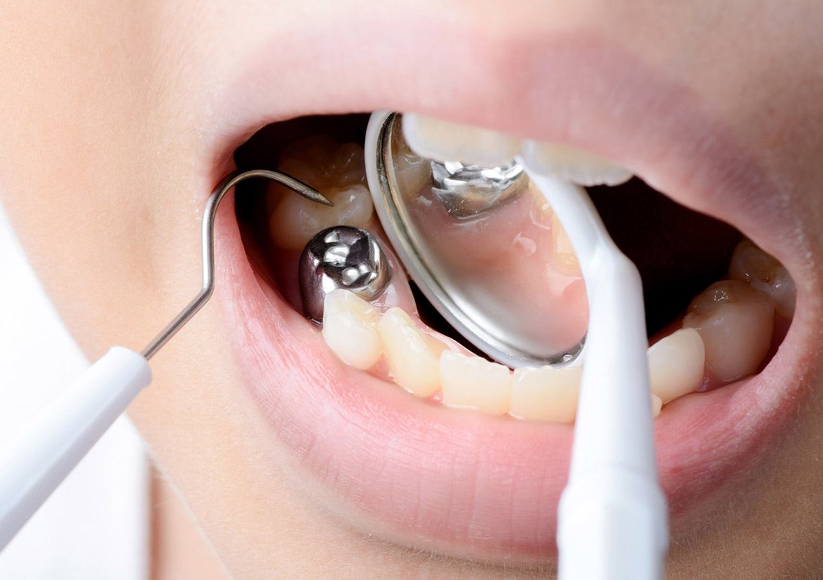 Use of mercury in dental fillings drops over 93 percent: Study