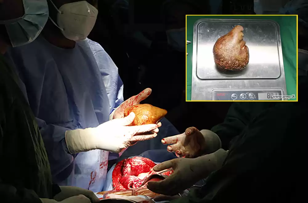 Sri Lanka doctors remove ‘world’s largest kidney stone’