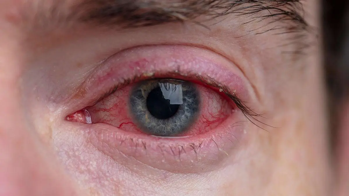 Conjunctivitis: follow these expert guidelines to prevent infection