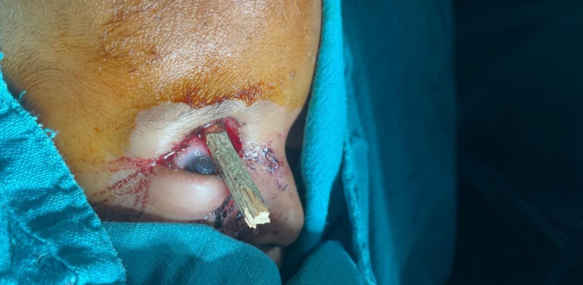 5-year-old’s boy undero successful eye surgery