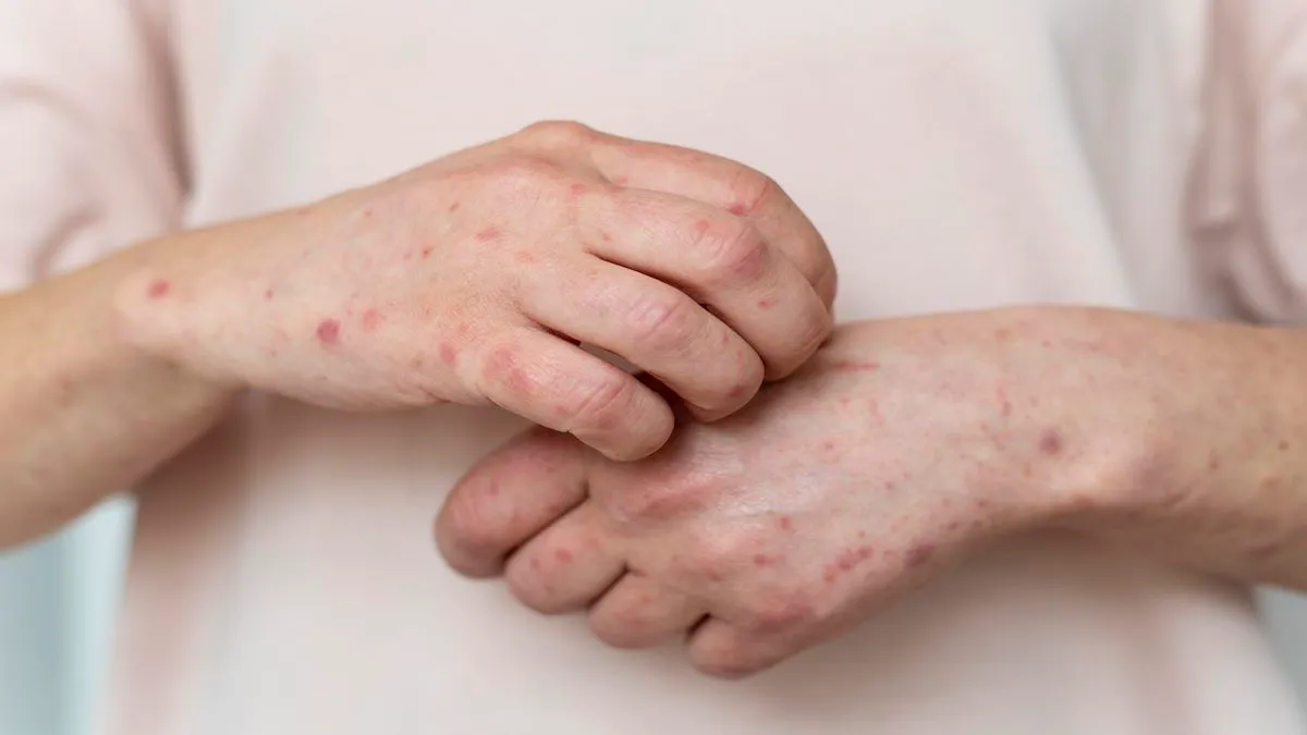 Number of patients with skin allergy increase in Banke