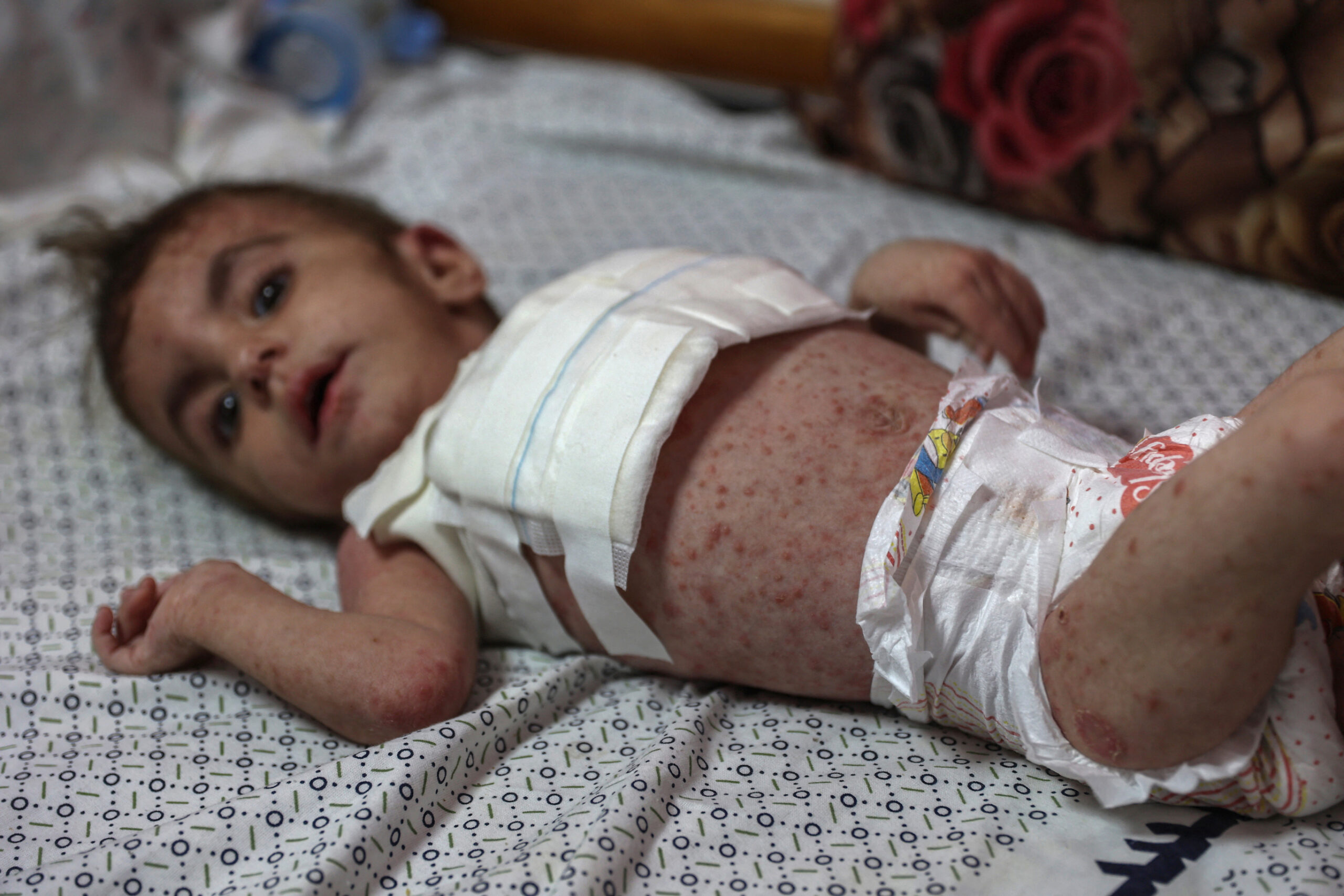 Dangerous skin diseases spreading among Gaza children
