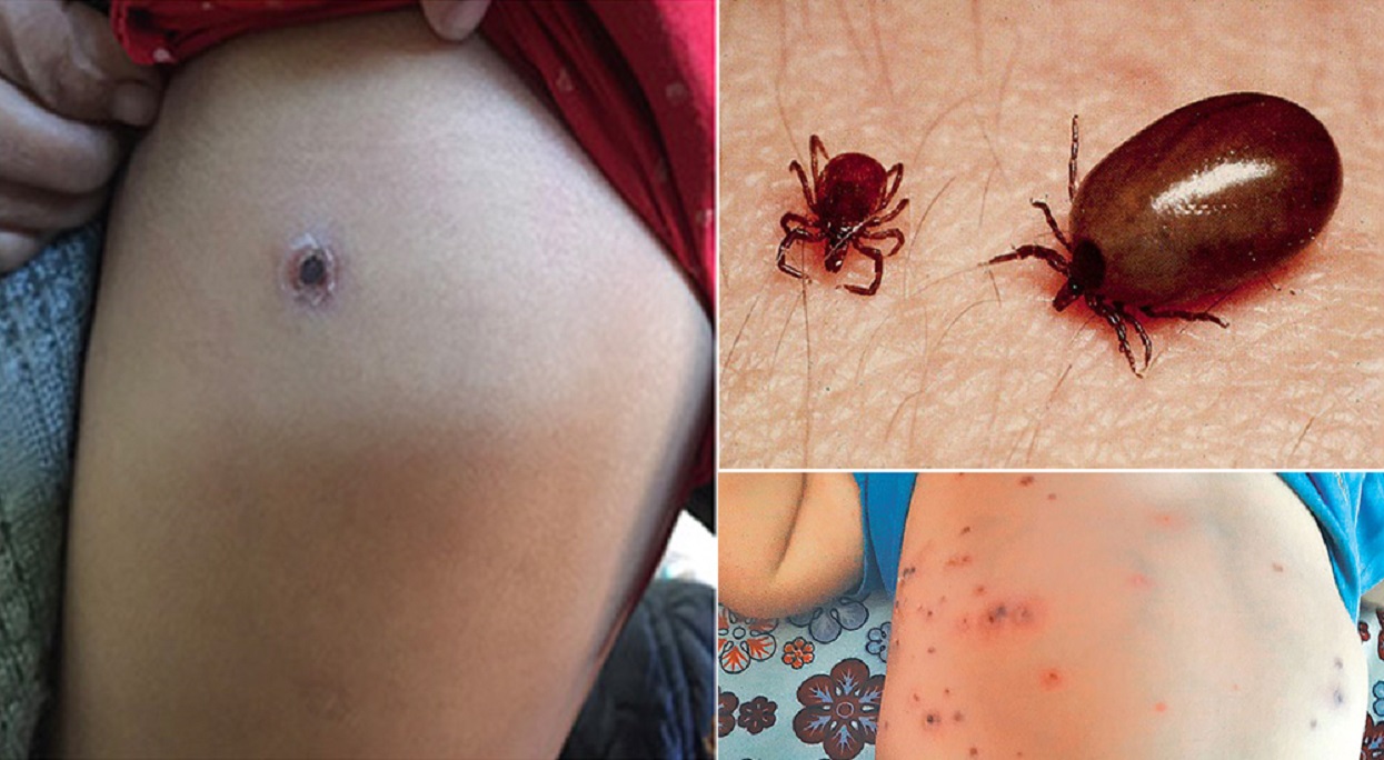 78 cases of scrub typhus diagnosed since July