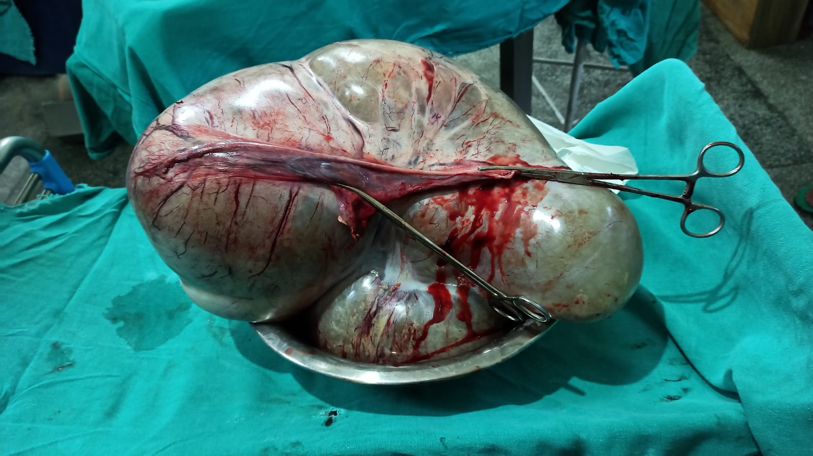 18.6 kg tumor successfully removed from ovarian cyst in BPKIHS