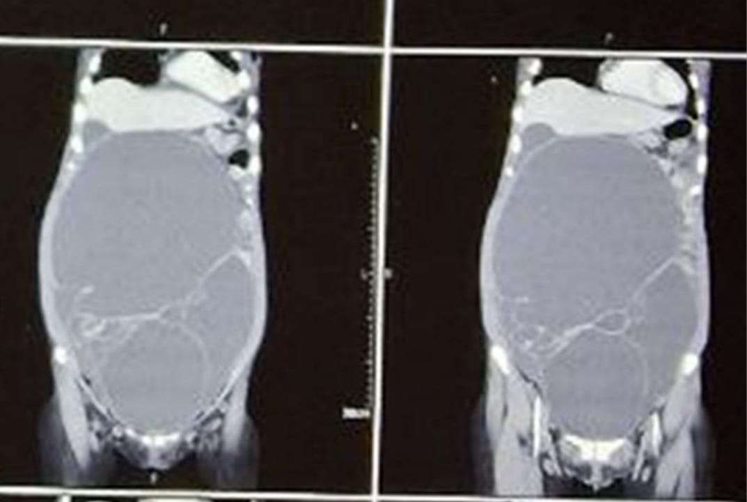 18.6 kg tumor successfully removed from ovarian cyst in BPKIHS