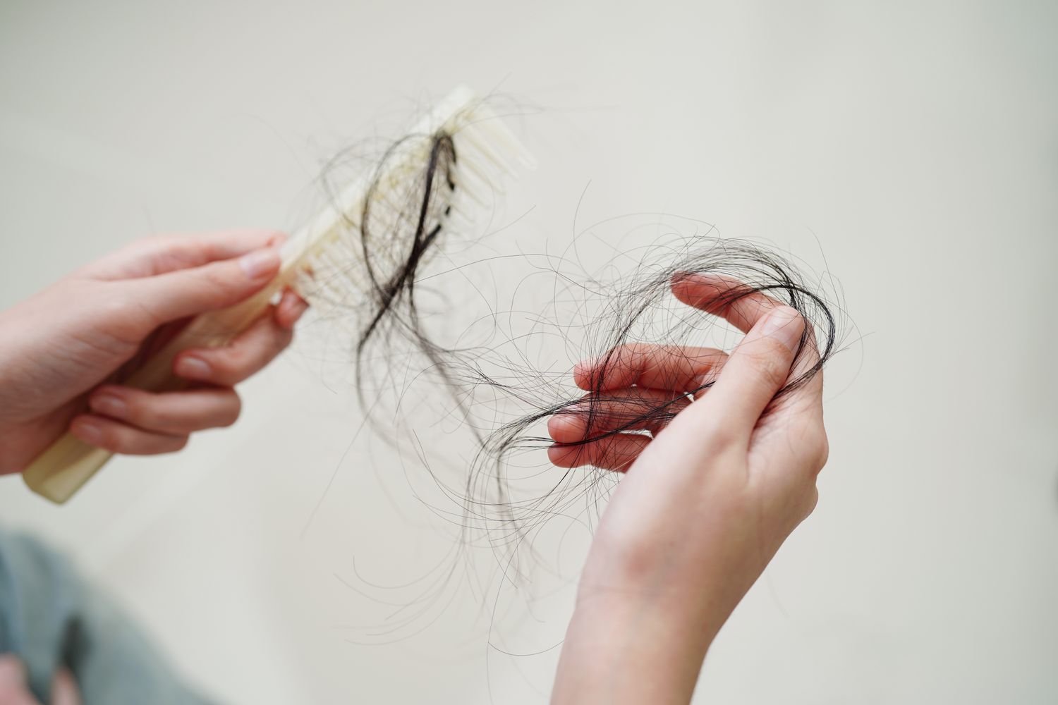 Rising hair fall cases: Experts warn of lifestyle & nutritional deficiencies