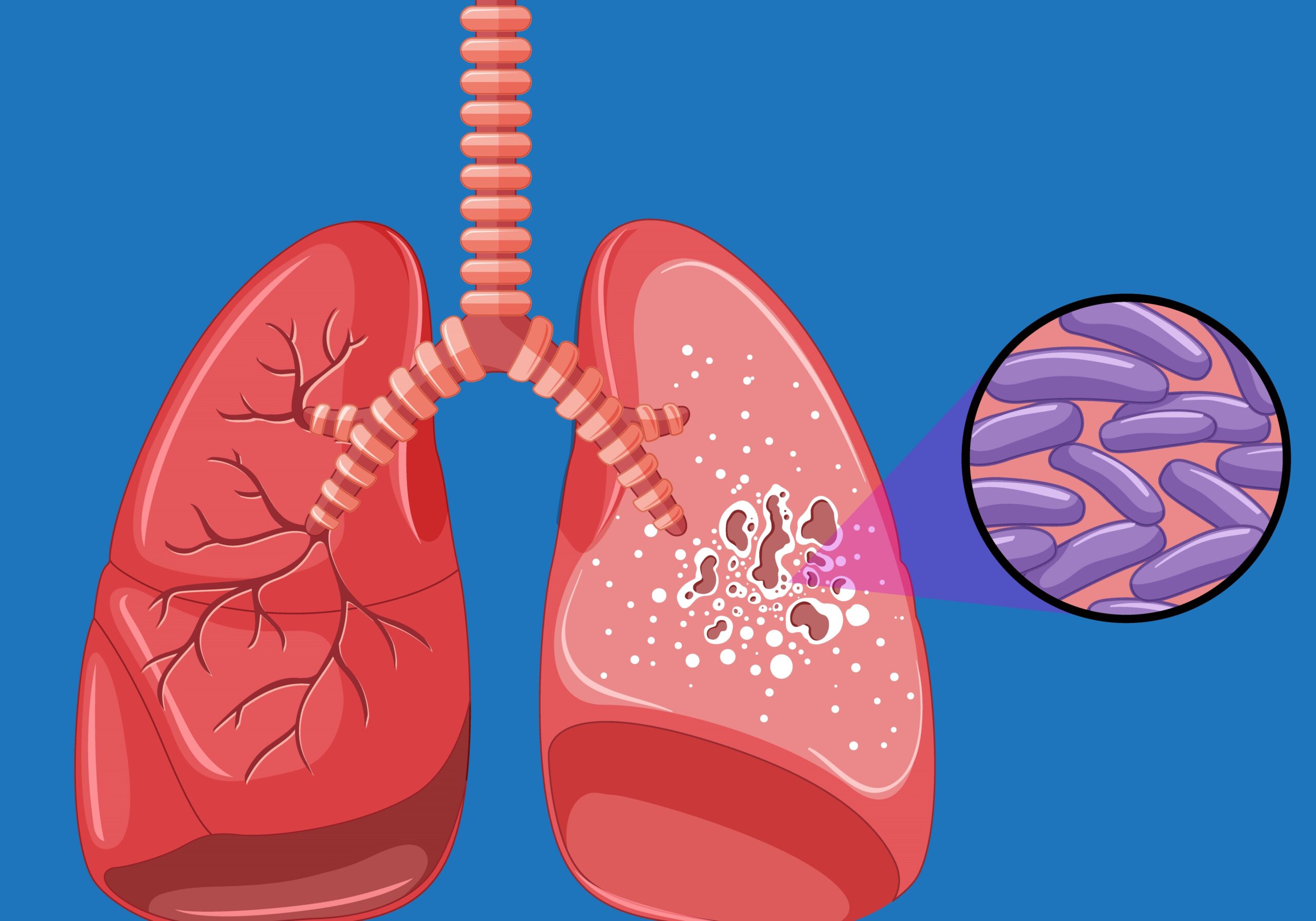 616 new tuberculosis cases detected in Jhapa