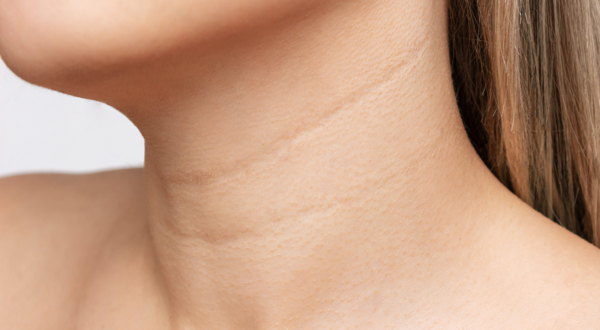 Why neck wrinkles appear at any age?