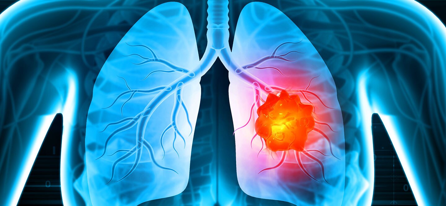 NCDs surge in Nepal: Heart, cancer, and lung diseases lead
