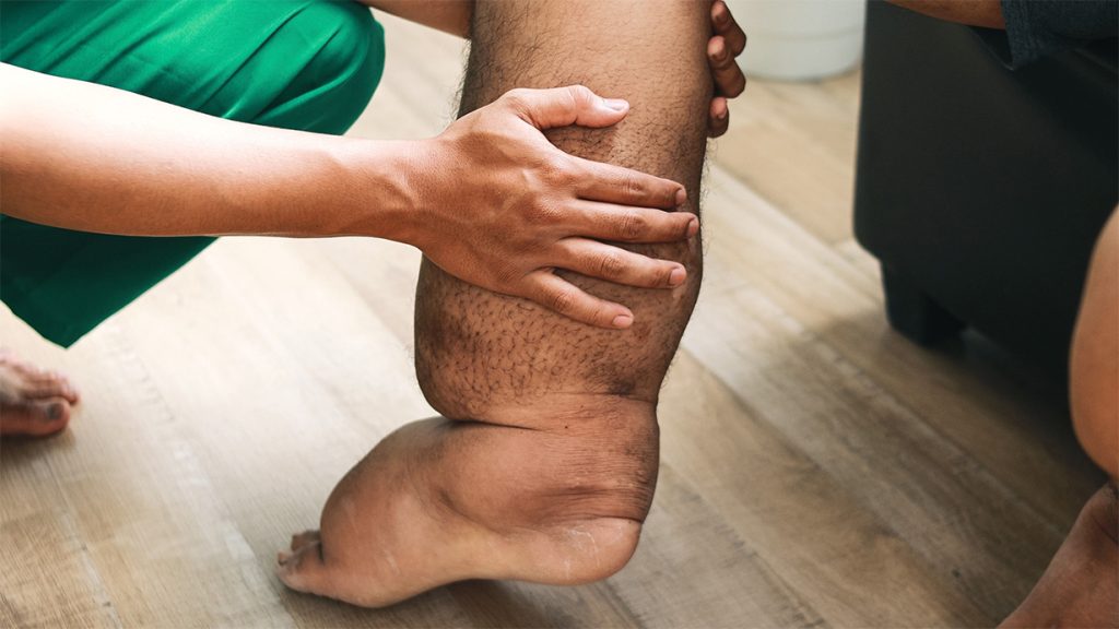 Over 400 thousand people in Sarlahi district to receive medication against elephantiasis